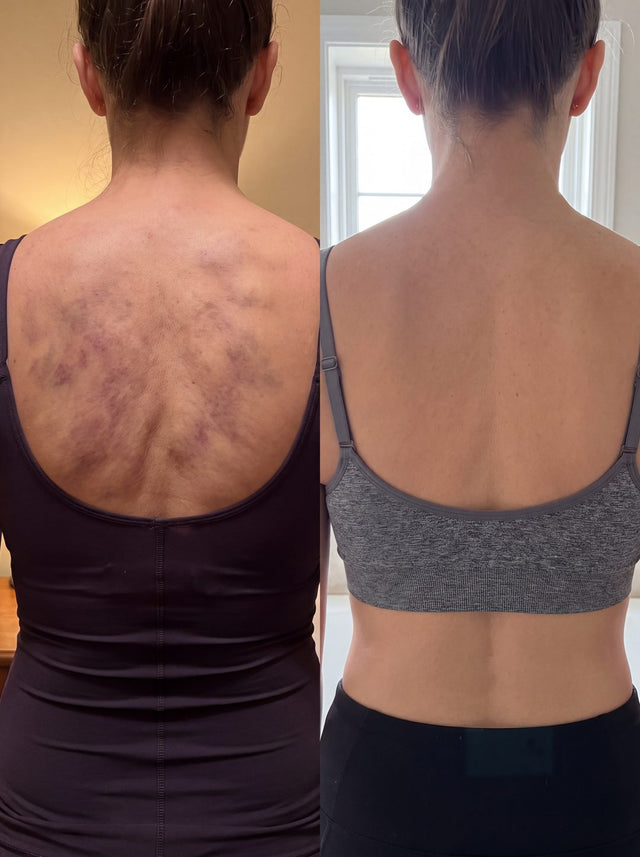 Before and after with Nova — Bruising and swelling across the back, visibly down.