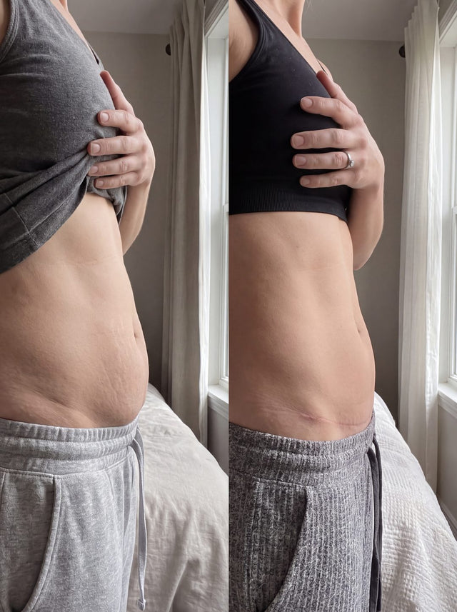Before and after with Nova — Post-tummy-tuck swelling down, waistline visibly softer.
