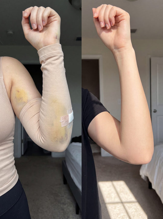 Before and after with Nova — Arm swelling and bruising, visibly calmer.