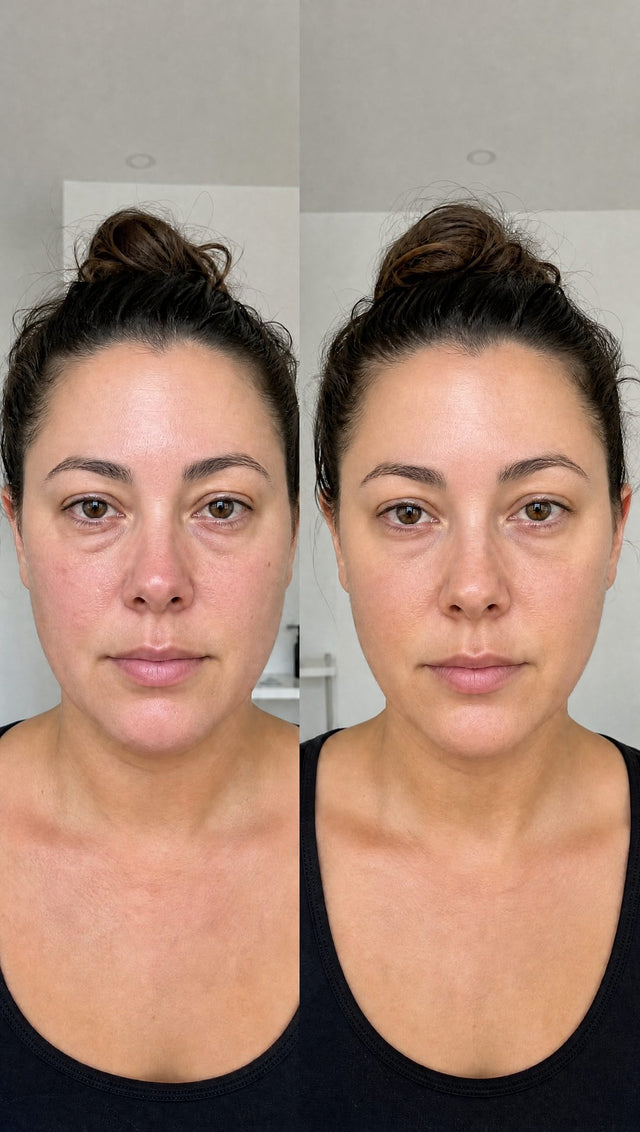Before and after — Under-eye and cheek puffiness, visibly calmer.